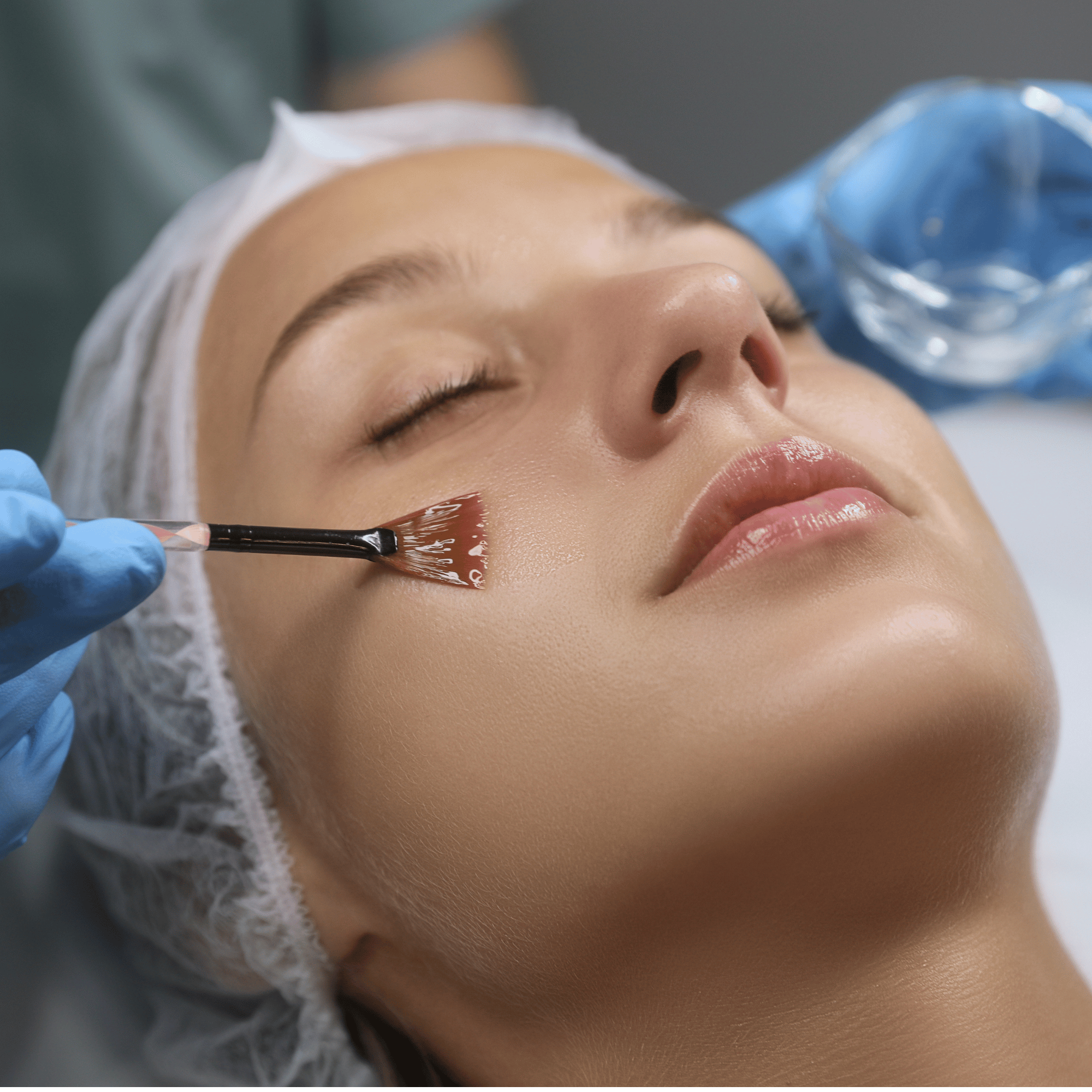 ChemicalPeel1_27c12980-f640-4c42-b6c1-0d1bf26e1fb5.png