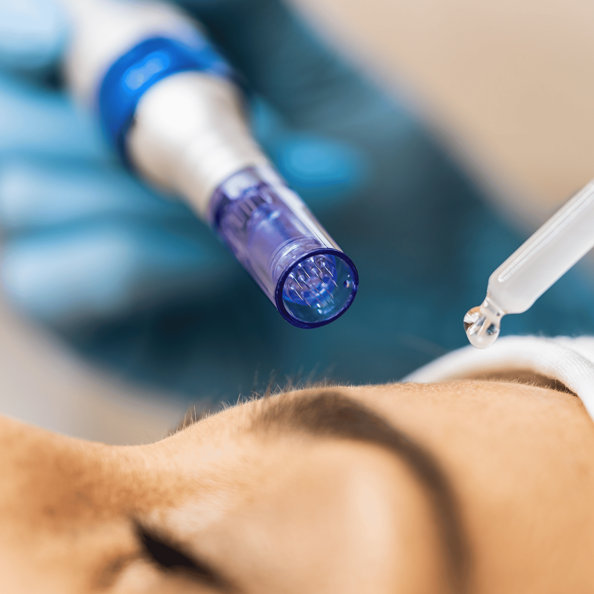 MICRONEEDLING