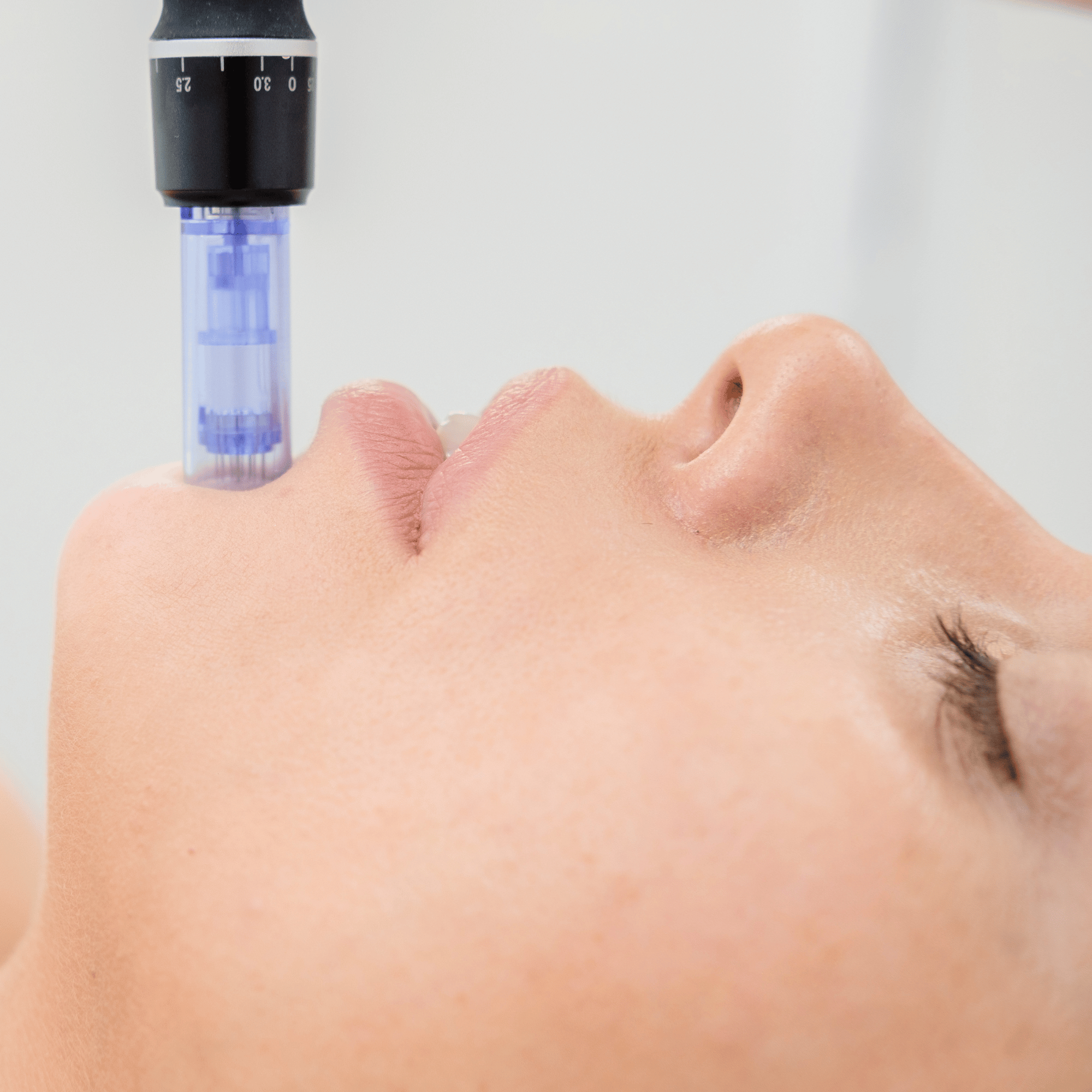 MICRONEEDLING