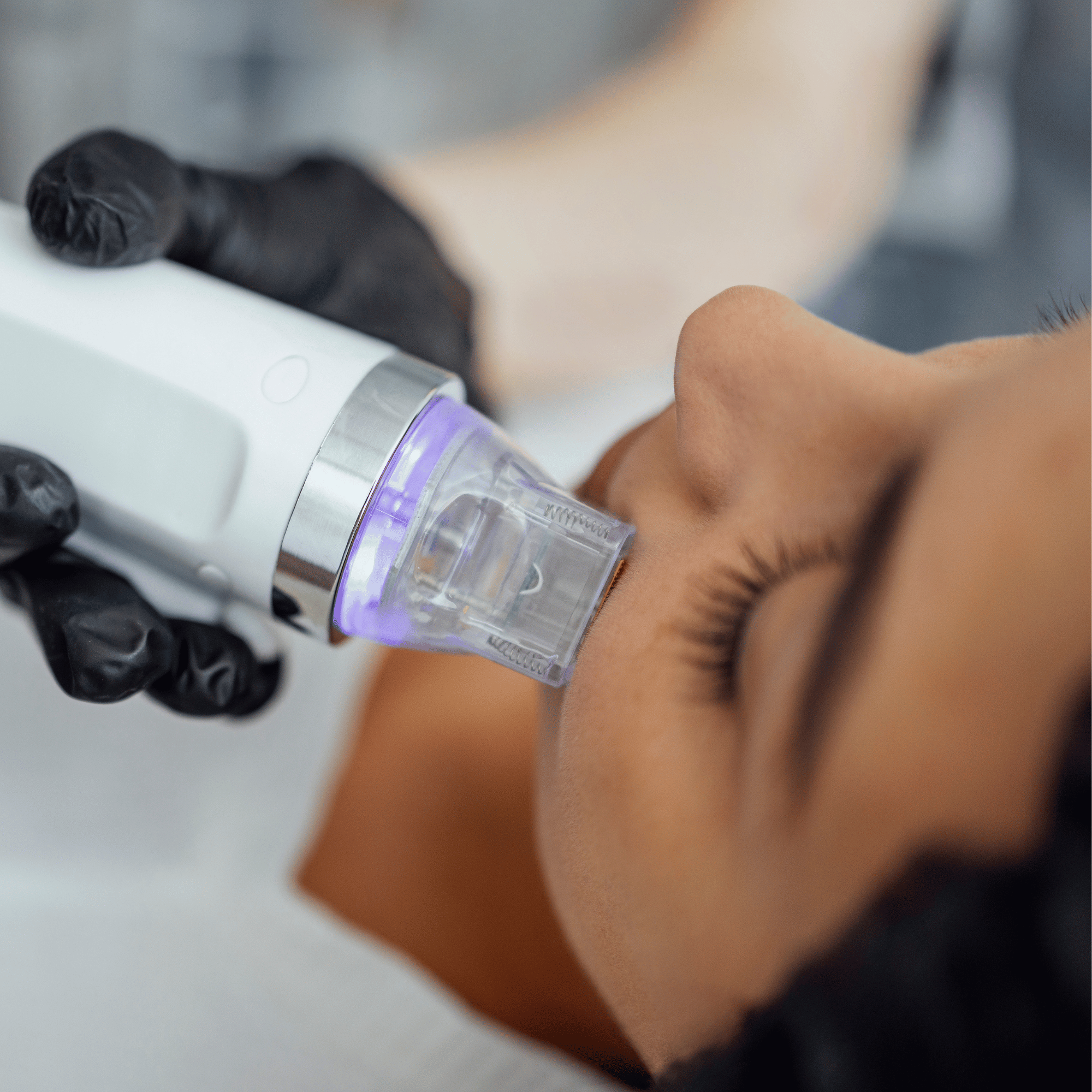 RADIOFREQUENCY MICRONEEDLING FACE