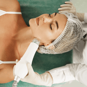 RADIOFREQUENCY MICRONEEDLING FACE